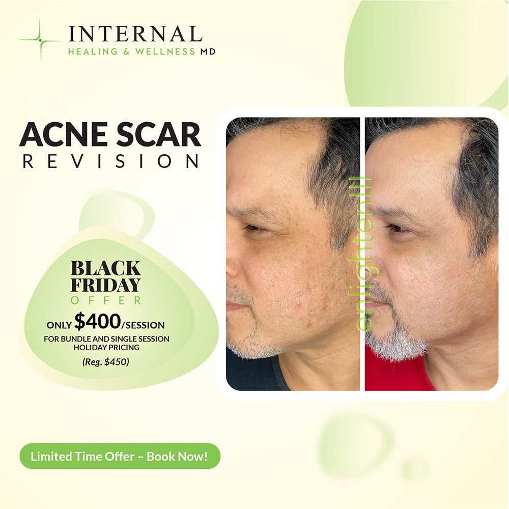 ACNE SCAR REVISION