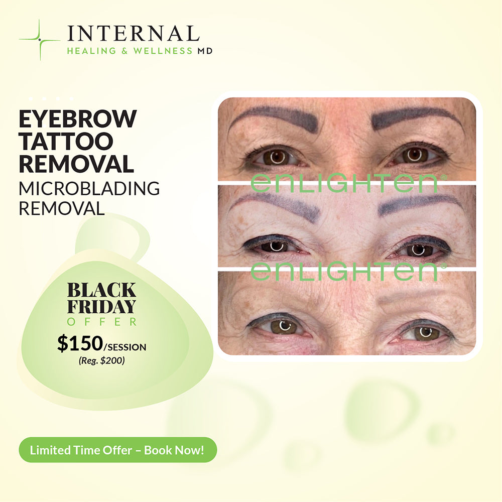 EYEBROW TATTOO REMOVAL