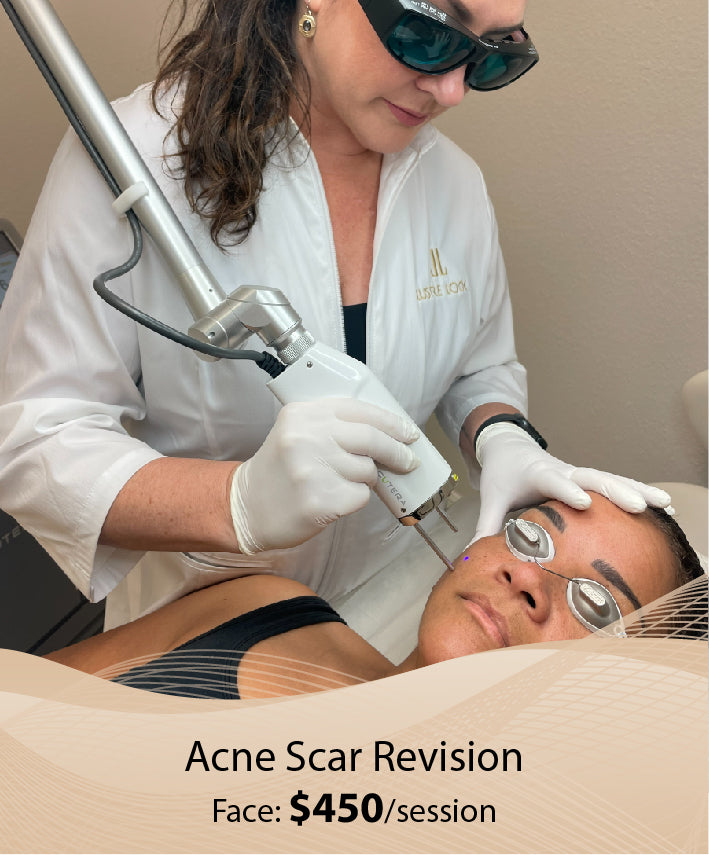 Acne Scar Revision (Face - Single Session )