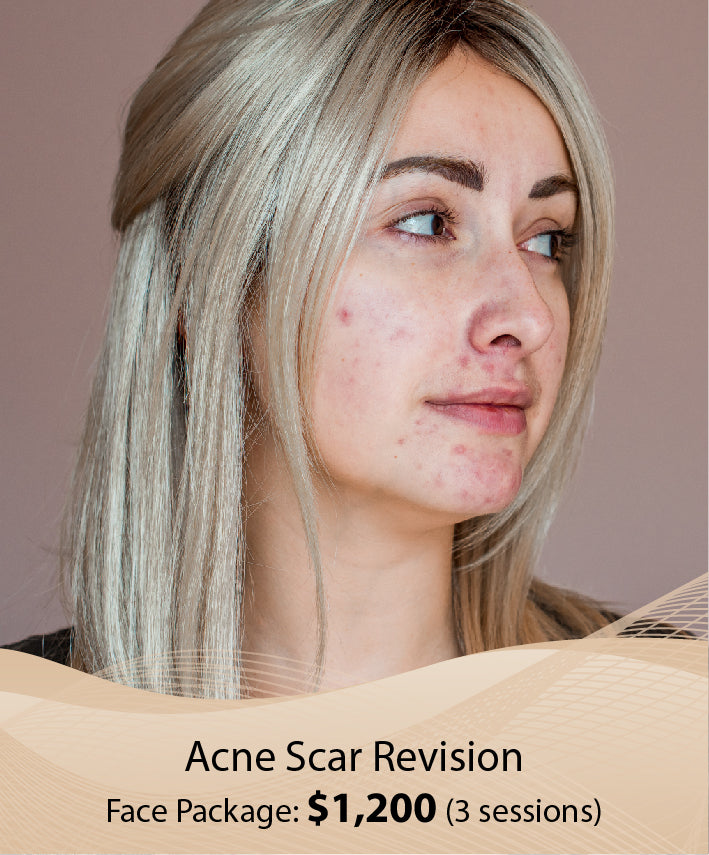 Acne Scar Revision (Face Package - 3 sessions)