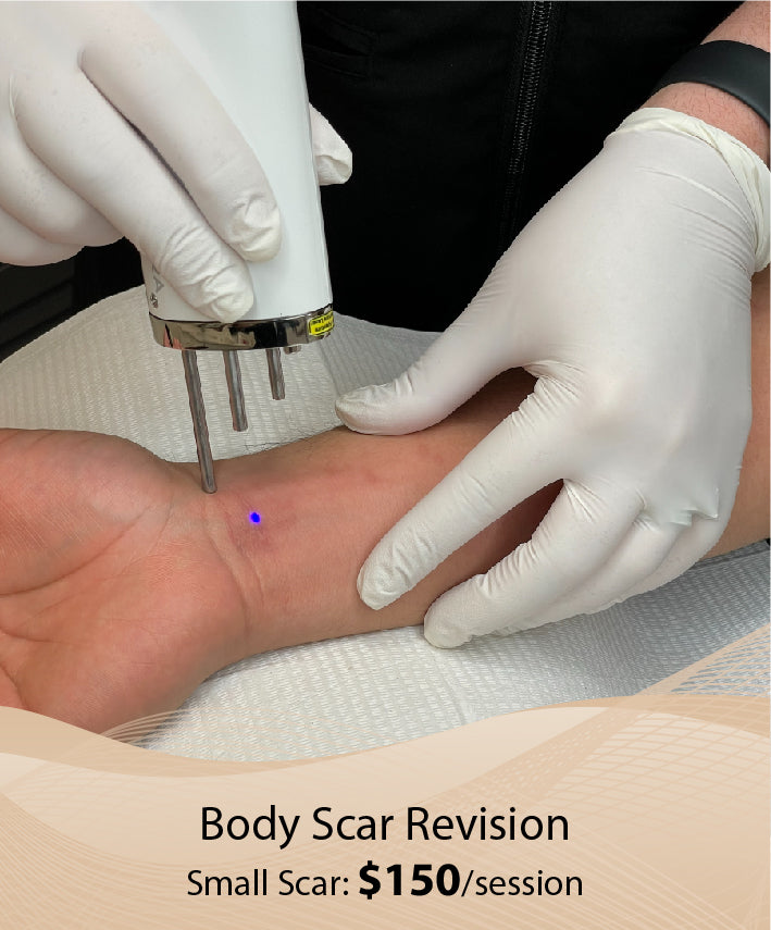 Body Scar Revision  (Small Scar - Single Session)