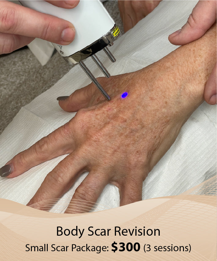 Body Scar Revision  (Small Scar Package - 3 Session)