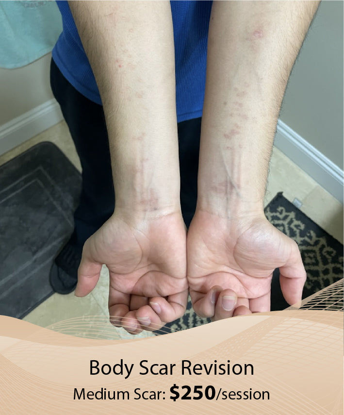 Body Scar Revision  (Medium Scar - Single Session)