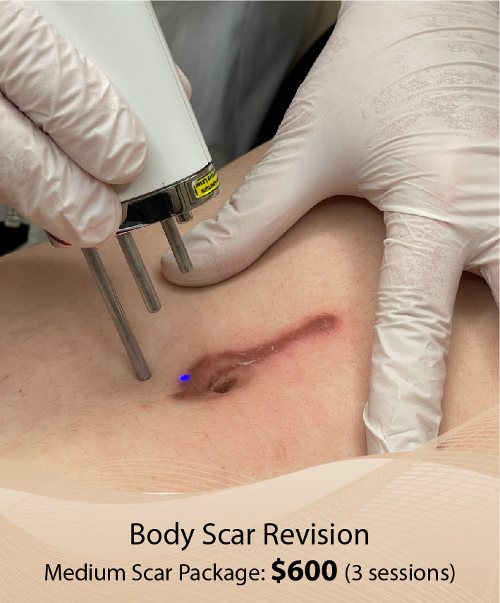 Body Scar Revision  (Medium Scar Package - 3 Session)