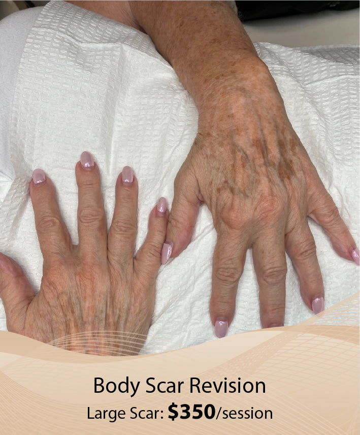 Body Scar Revision  (Large Scar - Single Session)