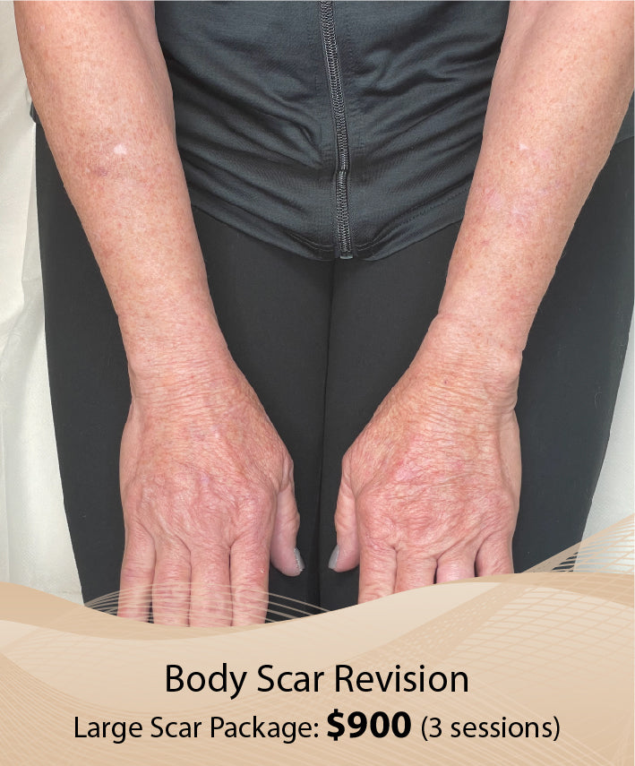 Body Scar Revision  (Large Scar Package - 3 Session)