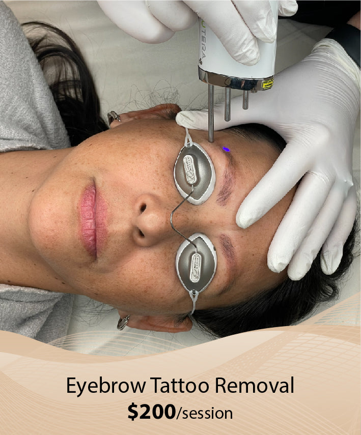 Eyebrow Tattoo Removal  (Single Session)