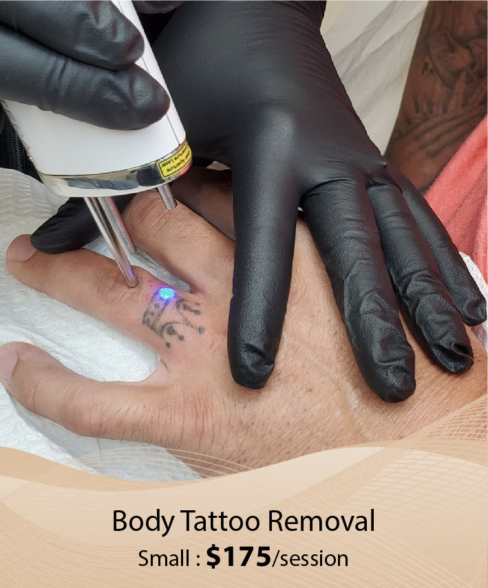 Body Tattoo Removal (Small - Single Session)