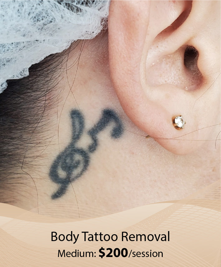 Body Tattoo Removal  (Medium - Single Session)