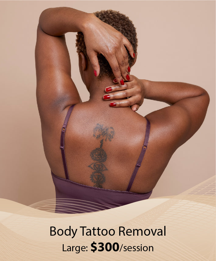 Body Tattoo Removal (Large - Single Session)