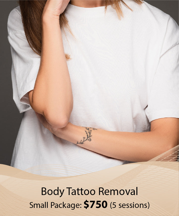 Body Tattoo Removal (Small Package - 5 Session)