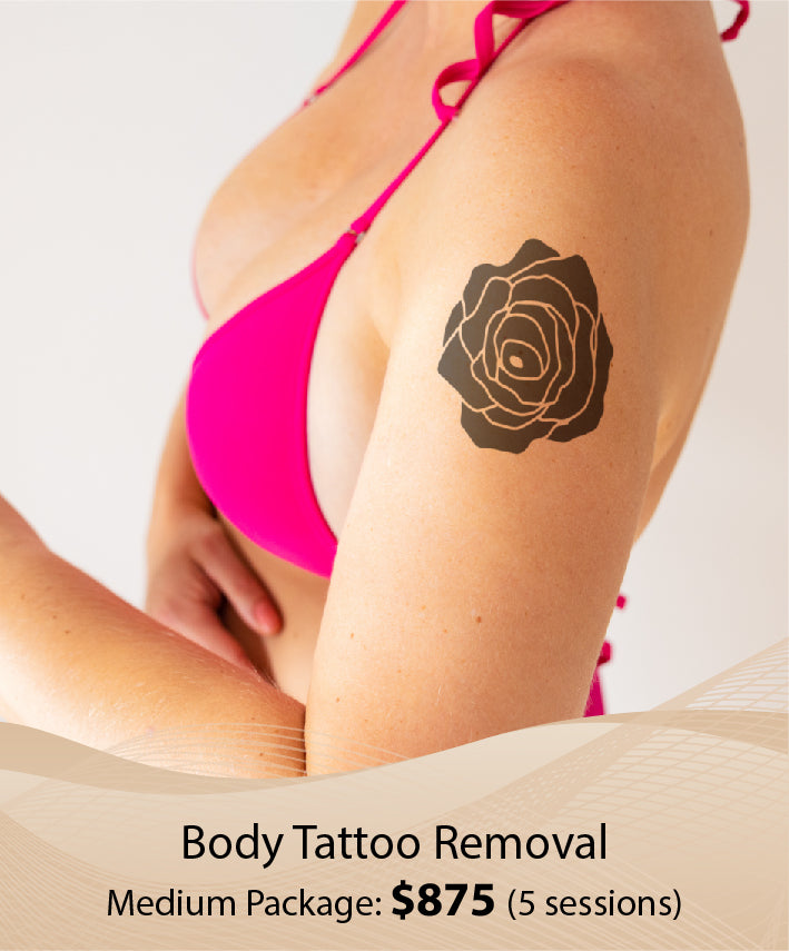 Body Tattoo Removal  (Medium Package - 5 Session)