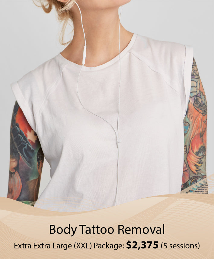 Body Tattoo Removal (Extra Extra Large (XXL) Package - 5 Session)